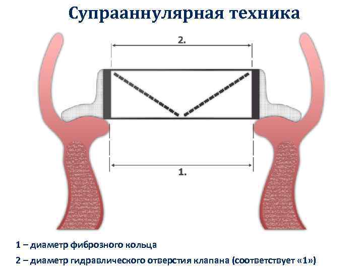 Супрааннулярная техника 1 – диаметр фиброзного кольца 2 – диаметр гидравлического отверстия клапана (соответствует