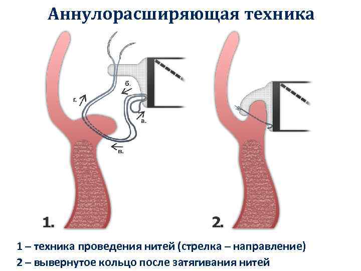 Аннулорасширяющая техника 1 – техника проведения нитей (стрелка – направление) 2 – вывернутое кольцо