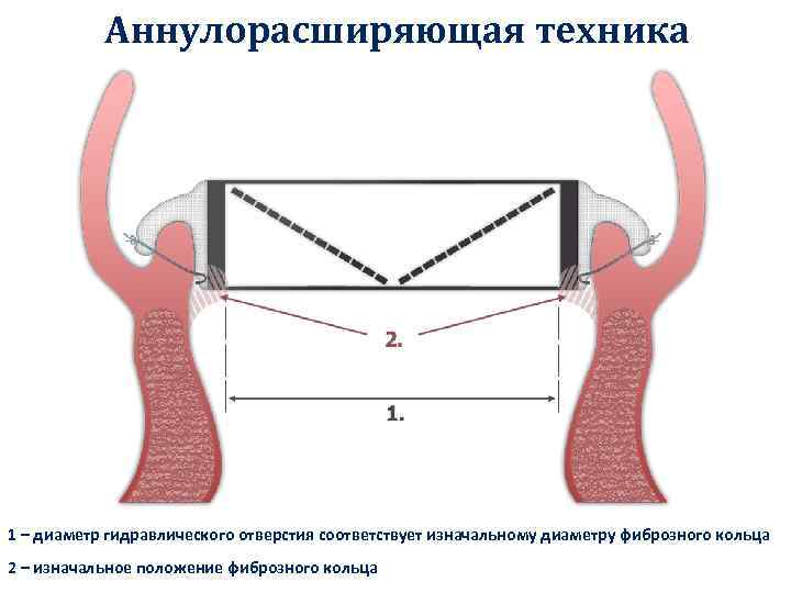 Аннулорасширяющая техника 1 – диаметр гидравлического отверстия соответствует изначальному диаметру фиброзного кольца 2 –