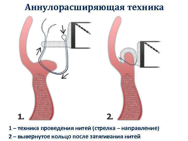 Аннулорасширяющая техника 1 – техника проведения нитей (стрелка – направление) 2 – вывернутое кольцо