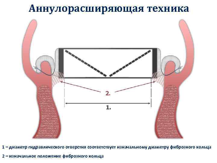 Аннулорасширяющая техника 1 – диаметр гидравлического отверстия соответствует изначальному диаметру фиброзного кольца 2 –