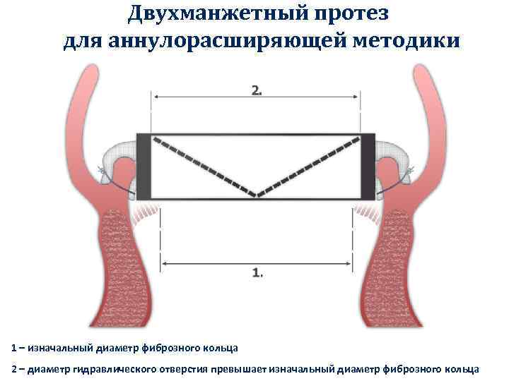 Двухманжетный протез для аннулорасширяющей методики 1 – изначальный диаметр фиброзного кольца 2 – диаметр