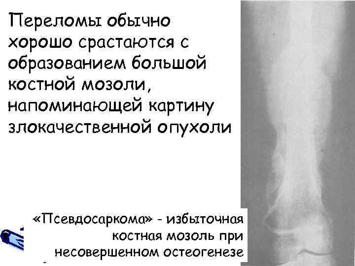 Переломы обычно хорошо срастаются с образованием большой костной мозоли, напоминающей картину злокачественной опухоли «Псевдосаркома»