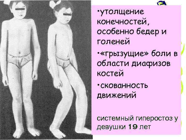 • утолщение конечностей, особенно бедер и голеней • «грызущие» боли в области диафизов