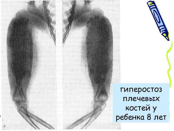 гиперостоз плечевых костей у ребенка 8 лет 