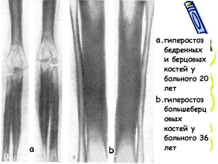 Несовершенный остеогенез 3 тип фото