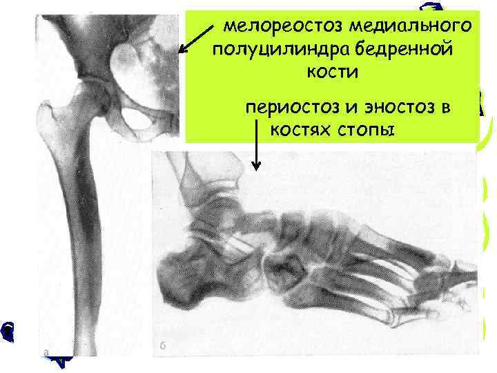 Мелореостоз