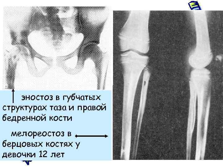 Мелореостоз