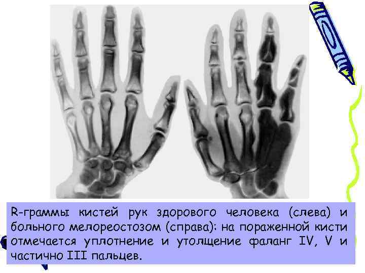 R-граммы кистей рук здорового человека (слева) и больного мелореостозом (справа): на пораженной кисти отмечается