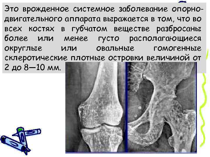 Это врожденное системное заболевание опорнодвигательного аппарата выражается в том, что во всех костях в