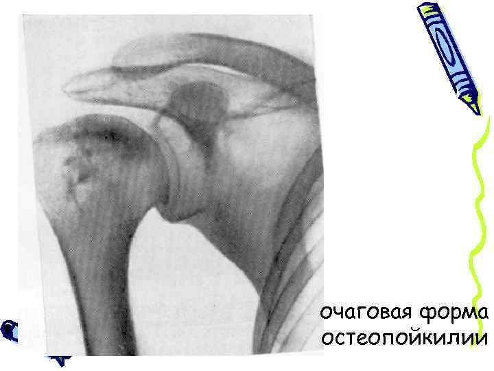 очаговая форма остеопойкилии 