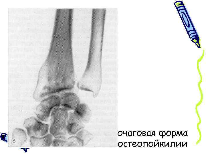 очаговая форма остеопойкилии 