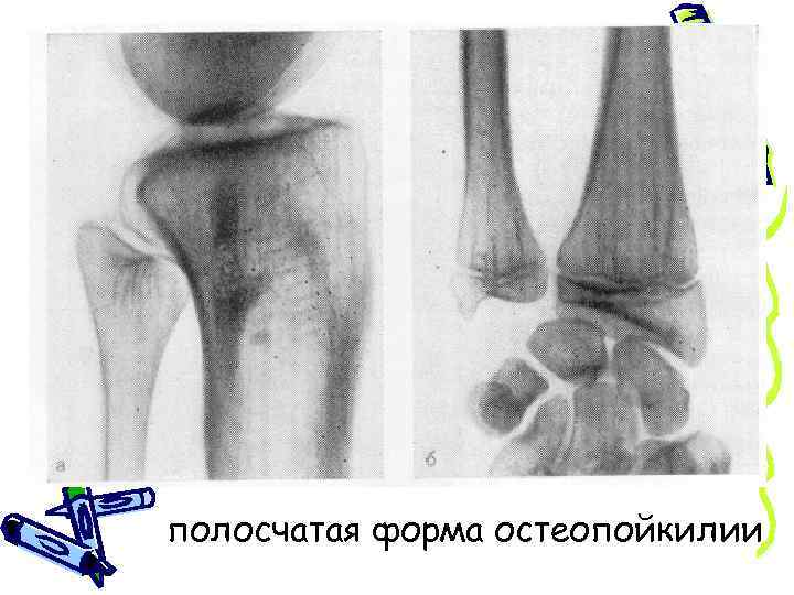 полосчатая форма остеопойкилии 