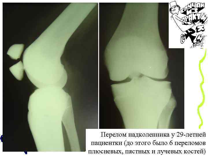 Перелом надколенника у 29 -летней пациентки (до этого было 6 переломов плюсневых, пястных и