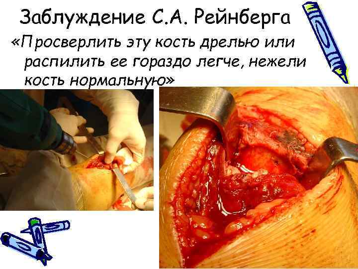 Заблуждение С. А. Рейнберга «Просверлить эту кость дрелью или распилить ее гораздо легче, нежели