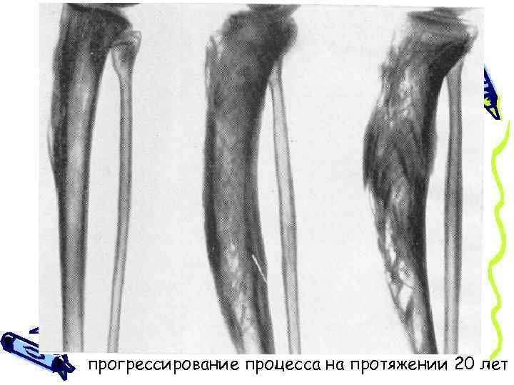 прогрессирование процесса на протяжении 20 лет 
