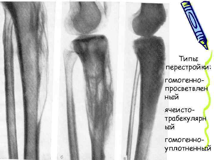 Типы перестройки: гомогеннопросветвлен ный ячеистотрабекулярн ый гомогенноуплотненный 