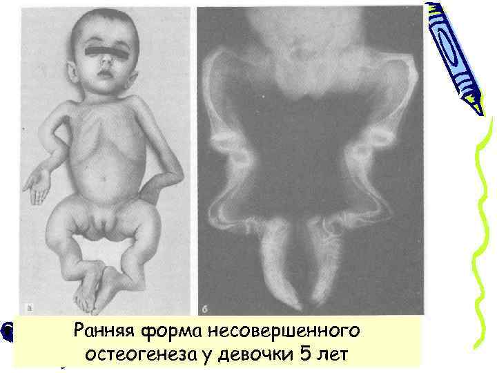 Ранняя форма несовершенного остеогенеза у девочки 5 лет 
