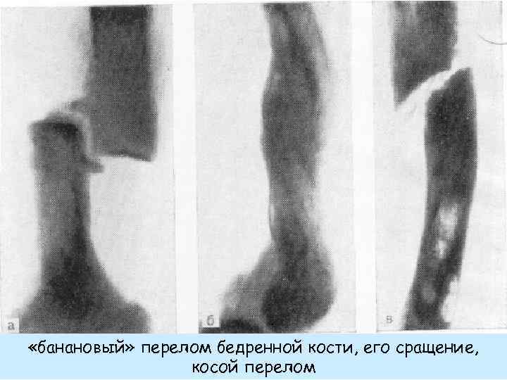 Кость срастается время. Цементно костная дисплазия. Периапикальная цементно костная дисплазия. Остеогенез бедренной кости.