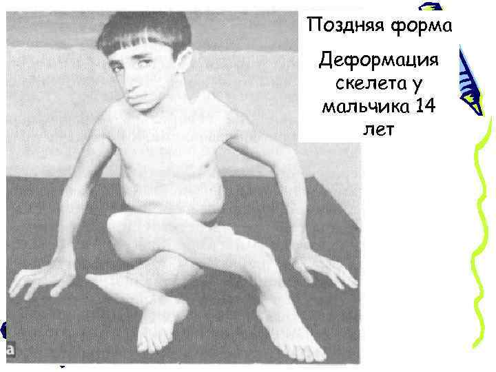 Поздняя форма Деформация скелета у мальчика 14 лет 