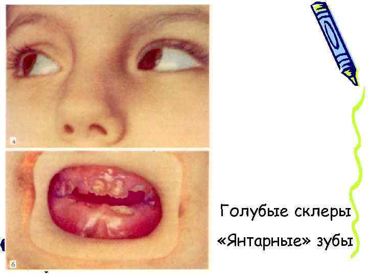 Голубые склеры «Янтарные» зубы 