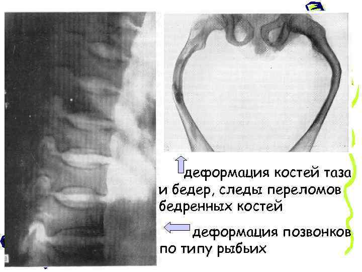 Несовершенный остеогенез 3 тип фото