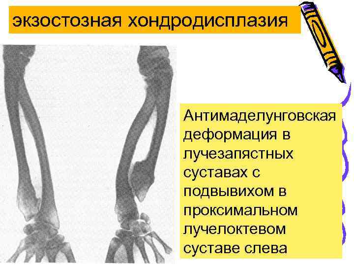 экзостозная хондродисплазия Антимаделунговская деформация в лучезапястных суставах с подвывихом в проксимальном лучелоктевом суставе слева