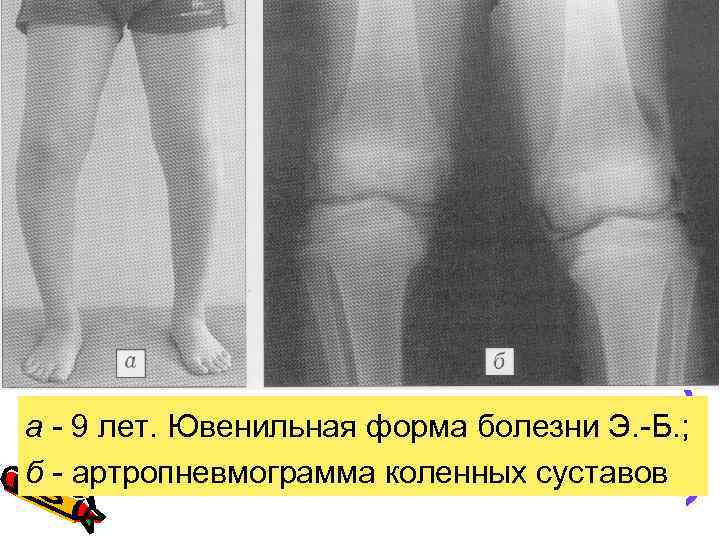 а - 9 лет. Ювенильная форма болезни Э. -Б. ; б - артропневмограмма коленных