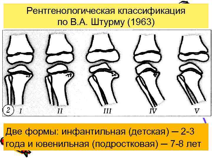 Рентгенологическая классификация по В. А. Штурму (1963) Две формы: инфантильная (детская) ─ 2 -3