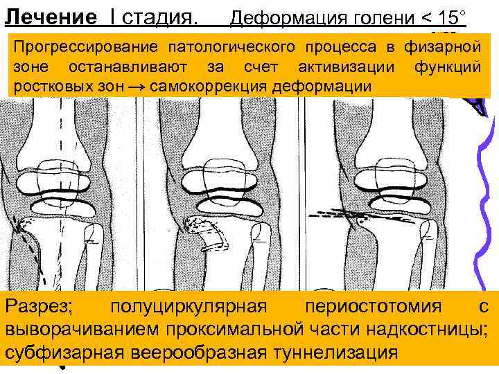 Лечение I стадия. Деформация голени < 15° Прогрессирование патологического процесса в физарной зоне останавливают