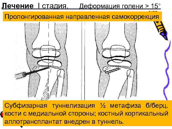 Лечение I стадия. Деформация голени > 15° Пролонгированная направленная самокоррекция Субфизарная туннелизация ½ метафиза