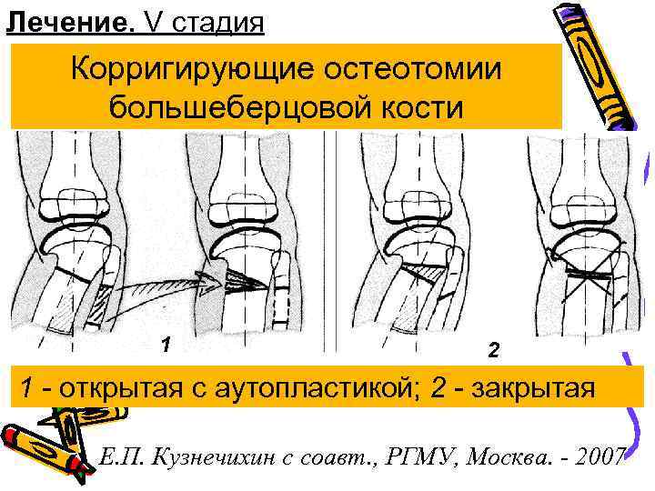 Лечение. V стадия Корригирующие остеотомии большеберцовой кости 1 2 1 - открытая с аутопластикой;