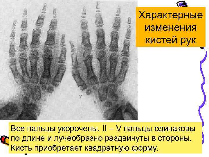 Характерные изменения кистей рук Все пальцы укорочены. II – V пальцы одинаковы по длине