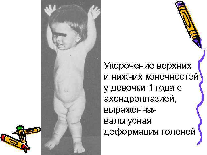 Укорочение верхних и нижних конечностей у девочки 1 года с ахондроплазией, выраженная вальгусная деформация