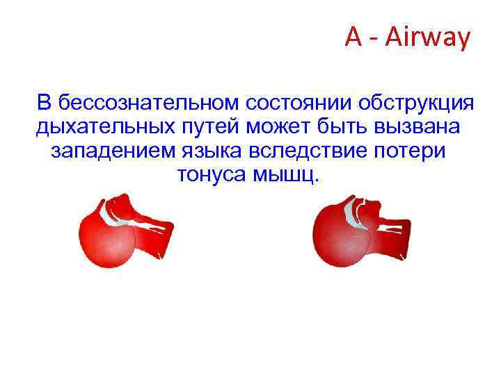 A - Airway В бессознательном состоянии обструкция дыхательных путей может быть вызвана западением языка