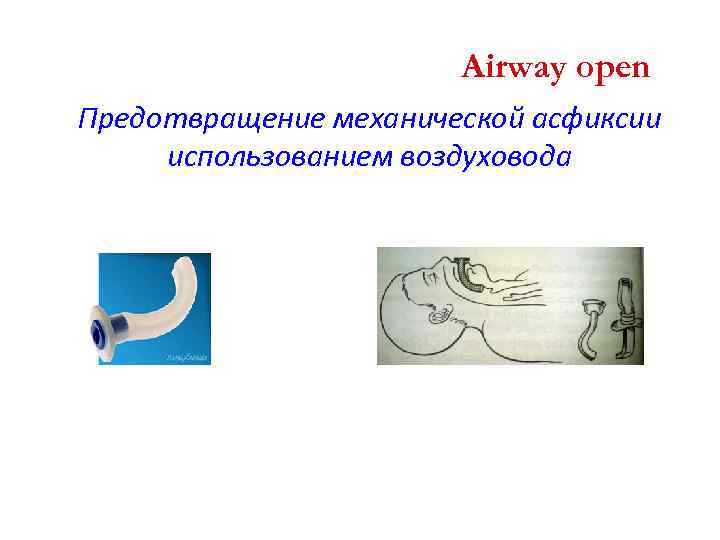 Airway open Предотвращение механической асфиксии использованием воздуховода 