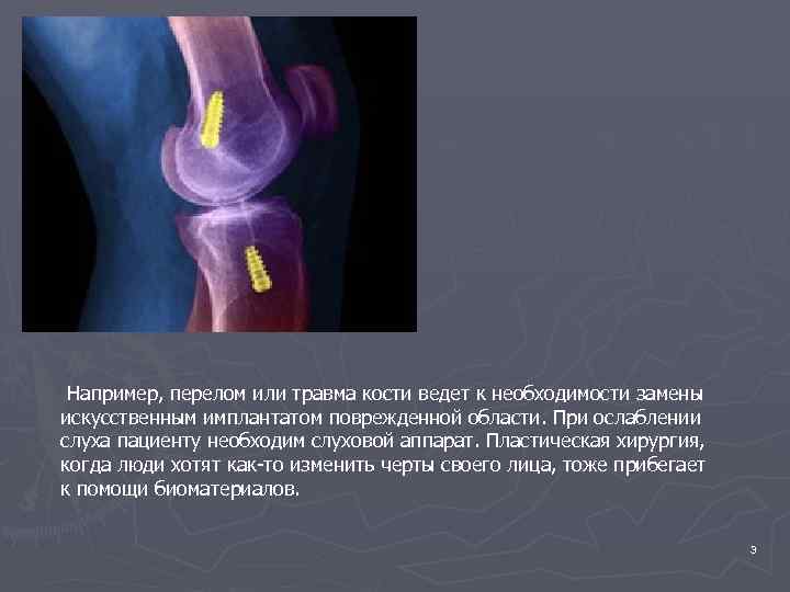 Например, перелом или травма кости ведет к необходимости замены искусственным имплантатом поврежденной области. При