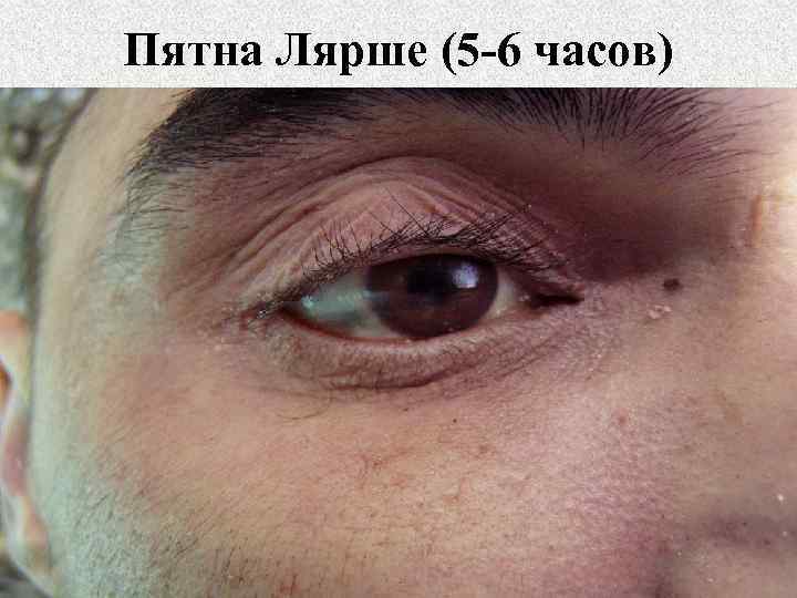Пятна Лярше (5 -6 часов) 