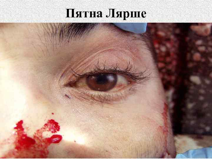 Пятна Лярше 