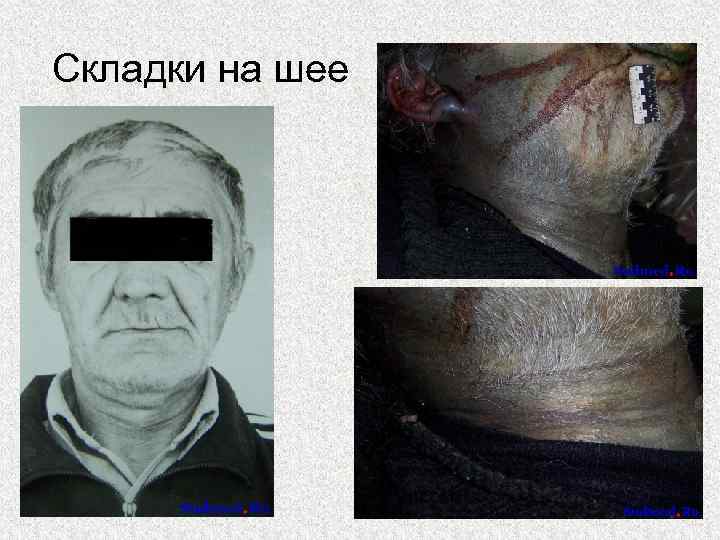 Складки на шее 