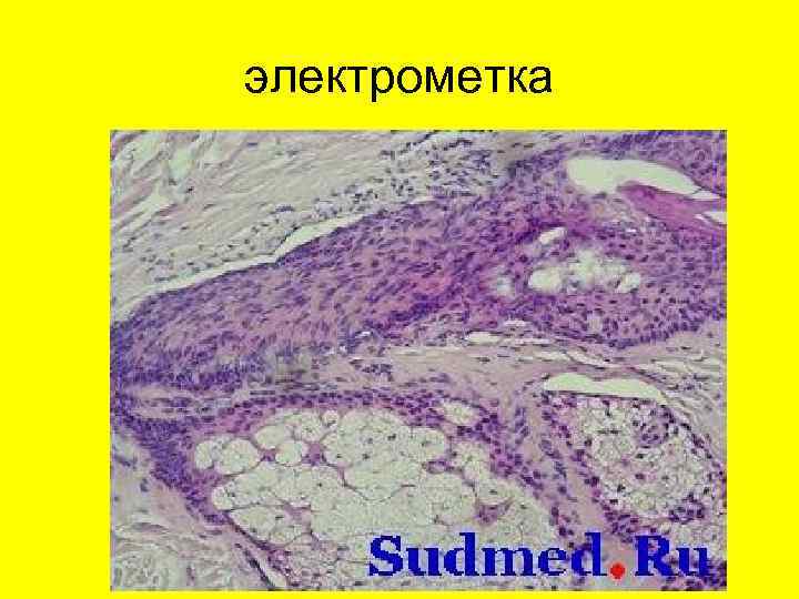 электрометка 