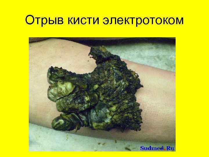 Отрыв кисти электротоком 
