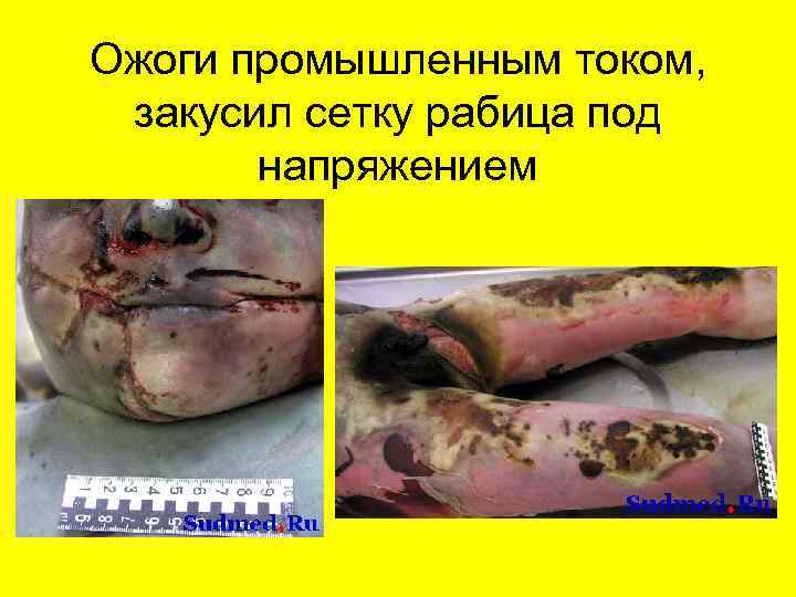 Ожоги промышленным током, закусил сетку рабица под напряжением 