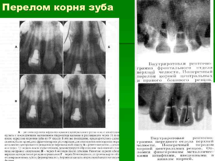 Перелом корня зуба презентация