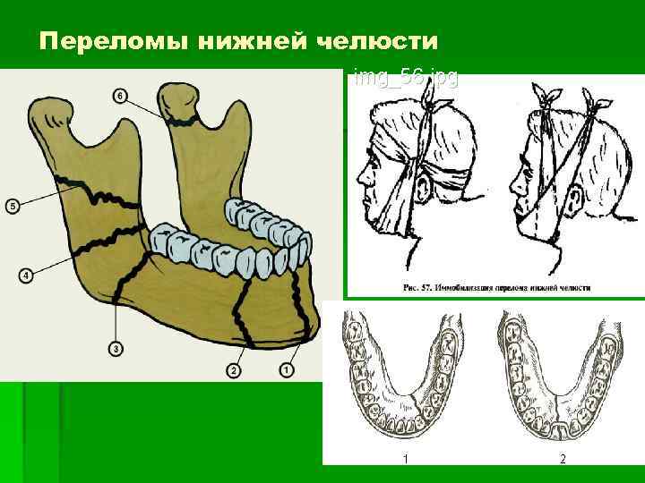 Перелом верхней челюсти карта вызова смп