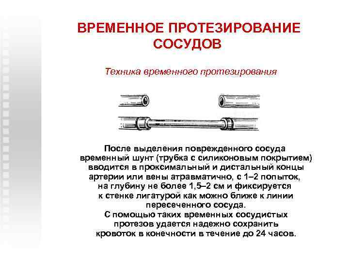 ВРЕМЕННОЕ ПРОТЕЗИРОВАНИЕ СОСУДОВ Техника временного протезирования После выделения поврежденного сосуда временный шунт (трубка с