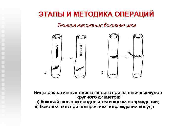 ЭТАПЫ И МЕТОДИКА ОПЕРАЦИЙ Техника наложения бокового шва а б Виды оперативных вмешательств при