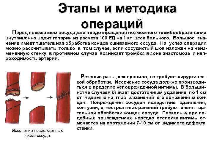 Этапы и методика операций Перед пережатием сосуда для предотвращения возможного тромбообразования внутривенно водят гепарин