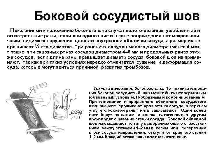 Боковой сосудистый шов Показаниями к наложению бокового шва служат колото-резаные, ушибленные и огнестрельные раны,