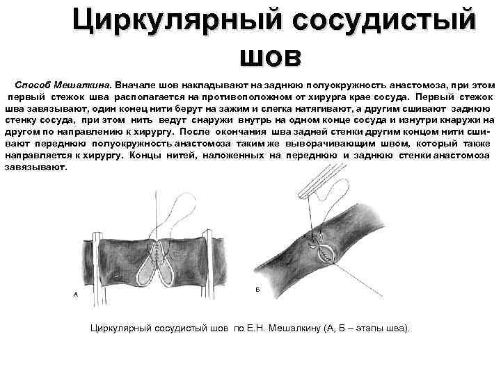 Циркулярный сосудистый шов Способ Мешалкина. Вначале шов накладывают на заднюю полуокружность анастомоза, при этом
